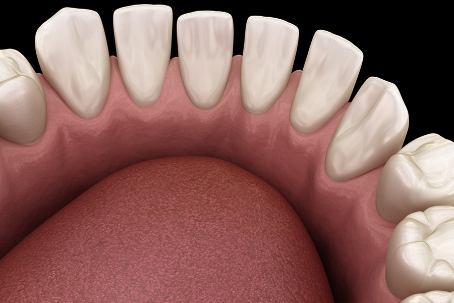 Gaps Between Teeth